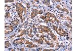 The image on the left is immunohistochemistry of paraffin-embedded Human breast cancer tissue using CSB-PA555295(EIF2AK4 Antibody) at dilution 1/50, on the right is treated with fusion protein. (Original magnification: 