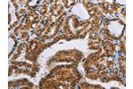 The image on the left is immunohistochemistry of paraffin-embedded Human thyroid cancer tissue using CSB-PA555438(ACVR1B Antibody) at dilution 1/55, on the right is treated with fusion protein. (Original magnification: 