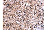 The image on the left is immunohistochemistry of paraffin-embedded Human esophagus cancer tissue using CSB-PA555803(AMIGO2 Antibody) at dilution 1/50, on the right is treated with fusion protein. (Original magnification: 