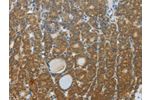 The image on the left is immunohistochemistry of paraffin-embedded Human thyroid cancer tissue using CSB-PA555880(DNAJC3 Antibody) at dilution 1/30, on the right is treated with fusion protein. (Original magnification: 