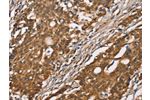 The image on the left is immunohistochemistry of paraffin-embedded Human gastic cancer tissue using CSB-PA556009(DICER1 Antibody) at dilution 1/40, on the right is treated with synthetic peptide. (Original magnification: 