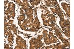 The image on the left is immunohistochemistry of paraffin-embedded Human breast cancer tissue using CSB-PA556194(CTNNBIP1 Antibody) at dilution 1/20, on the right is treated with fusion protein. (Original magnification: 