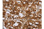 The image on the left is immunohistochemistry of paraffin-embedded Human thyroid cancer tissue using CSB-PA556201(COMP Antibody) at dilution 1/50, on the right is treated with fusion protein. (Original magnification: 