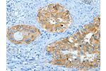 The image on the left is immunohistochemistry of paraffin-embedded Human cervical cancer tissue using CSB-PA556717(ANXA3 Antibody) at dilution 1/25, on the right is treated with fusion protein. (Original magnification: 