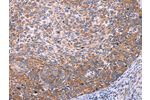 The image on the left is immunohistochemistry of paraffin-embedded Human cervical cancer tissue using CSB-PA557036(FUT8 Antibody) at dilution 1/20, on the right is treated with synthetic peptide. (Original magnification: 