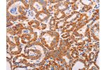 The image on the left is immunohistochemistry of paraffin-embedded Human thyroid cancer tissue using CSB-PA557372(ADAMTS17 Antibody) at dilution 1/60, on the right is treated with synthetic peptide. (Original magnification: 