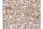 The image on the left is immunohistochemistry of paraffin-embedded Human liver cancer tissue using CSB-PA557863(CRHR2 Antibody) at dilution 1/25, on the right is treated with synthetic peptide. (Original magnification: 