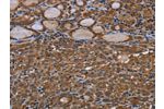 The image on the left is immunohistochemistry of paraffin-embedded Human thyroid cancer tissue using CSB-PA558294(GJB4 Antibody) at dilution 1/40, on the right is treated with synthetic peptide. (Original magnification: 