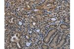 The image on the left is immunohistochemistry of paraffin-embedded Human thyroid cancer tissue using CSB-PA558316(GDF3 Antibody) at dilution 1/25, on the right is treated with fusion protein. (Original magnification: 