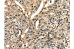 The image on the left is immunohistochemistry of paraffin-embedded Human gastic cancer tissue using CSB-PA558622(ANXA13 Antibody) at dilution 1/15, on the right is treated with fusion protein. (Original magnification: 
