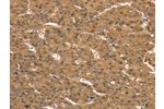 The image on the left is immunohistochemistry of paraffin-embedded Human liver cancer tissue using CSB-PA558771(CD97 Antibody) at dilution 1/35, on the right is treated with synthetic peptide. (Original magnification: 