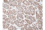 The image on the left is immunohistochemistry of paraffin-embedded Human esophagus cancer tissue using CSB-PA559486(CDX2 Antibody) at dilution 1/35, on the right is treated with synthetic peptide. (Original magnification: 