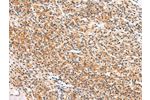 The image on the left is immunohistochemistry of paraffin-embedded Human prostate cancer tissue using CSB-PA560086(APLN Antibody) at dilution 1/20, on the right is treated with synthetic peptide. (Original magnification: 