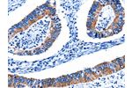 The image on the left is immunohistochemistry of paraffin-embedded Human colon cancer tissue using CSB-PA560952(CTSH Antibody) at dilution 1/5, on the right is treated with fusion protein. (Original magnification: 