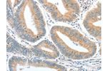 The image on the left is immunohistochemistry of paraffin-embedded Human colon cancer tissue using CSB-PA560972(CKAP2 Antibody) at dilution 1/50, on the right is treated with fusion protein. (Original magnification: 