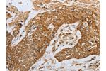 The image on the left is immunohistochemistry of paraffin-embedded Human esophagus cancer tissue using CSB-PA561050(CKM Antibody) at dilution 1/50, on the right is treated with synthetic peptide. (Original magnification: 