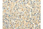 The image on the left is immunohistochemistry of paraffin-embedded Human liver cancer tissue using CSB-PA561188(EFNA3 Antibody) at dilution 1/25, on the right is treated with fusion protein. (Original magnification: 