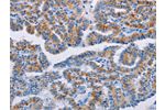The image on the left is immunohistochemistry of paraffin-embedded Human thyroid cancer tissue using CSB-PA561279(BCL2A1 Antibody) at dilution 1/20, on the right is treated with fusion protein. (Original magnification: 