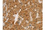 The image on the left is immunohistochemistry of paraffin-embedded Human liver cancer tissue using CSB-PA561433(CPA2 Antibody) at dilution 1/20, on the right is treated with fusion protein. (Original magnification: 