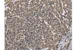 The image on the left is immunohistochemistry of paraffin-embedded Human cervical cancer tissue using CSB-PA561781(DCTN4 Antibody) at dilution 1/30, on the right is treated with fusion protein. (Original magnification: 