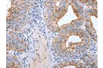 The image on the left is immunohistochemistry of paraffin-embedded Human cervical cancer tissue using CSB-PA561954(CLDN3 Antibody) at dilution 1/25, on the right is treated with synthetic peptide. (Original magnification: 