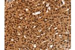 The image on the left is immunohistochemistry of paraffin-embedded Human breast cancer tissue using CSB-PA562564(ANKRD1 Antibody) at dilution 1/20, on the right is treated with fusion protein. (Original magnification: 
