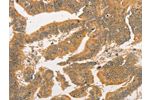The image on the left is immunohistochemistry of paraffin-embedded Human colon cancer tissue using CSB-PA562697(BCL2L14 Antibody) at dilution 1/40, on the right is treated with fusion protein. (Original magnification: 