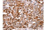 The image on the left is immunohistochemistry of paraffin-embedded Human thyroid cancer tissue using CSB-PA562827(GLMN Antibody) at dilution 1/40, on the right is treated with synthetic peptide. (Original magnification: 