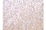 The image on the left is immunohistochemistry of paraffin-embedded Human esophagus cancer tissue using CSB-PA562872(ADIPOR1 Antibody) at dilution 1/20, on the right is treated with fusion protein. (Original magnification: 