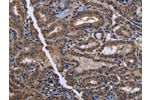 The image on the left is immunohistochemistry of paraffin-embedded Human thyroid cancer tissue using CSB-PA563111(CYP3A4 Antibody) at dilution 1/40, on the right is treated with fusion protein. (Original magnification: 