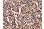 The image on the left is immunohistochemistry of paraffin-embedded Human liver cancer tissue using CSB-PA563307(GCG Antibody) at dilution 1/15, on the right is treated with synthetic peptide. (Original magnification: 