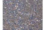 The image on the left is immunohistochemistry of paraffin-embedded Human Lymphoma tissue using CSB-PA563352(CD5L Antibody) at dilution 1/40, on the right is treated with synthetic peptide. (Original magnification: 