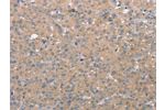 The image on the left is immunohistochemistry of paraffin-embedded Human liver cancer tissue using CSB-PA563396(CD97 Antibody) at dilution 1/25, on the right is treated with synthetic peptide. (Original magnification: 