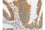 The image on the left is immunohistochemistry of paraffin-embedded Human colon cancer tissue using CSB-PA564021(ARHGAP5 Antibody) at dilution 1/30, on the right is treated with fusion protein. (Original magnification: 