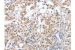 The image on the left is immunohistochemistry of paraffin-embedded Human thyroid cancer tissue using CSB-PA564323(CD200R1 Antibody) at dilution 1/70, on the right is treated with fusion protein. (Original magnification: 