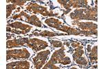 The image on the left is immunohistochemistry of paraffin-embedded Human breast cancer tissue using CSB-PA564388(EIF4EBP2 Antibody) at dilution 1/30, on the right is treated with fusion protein. (Original magnification: 
