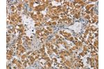 The image on the left is immunohistochemistry of paraffin-embedded Human thyroid cancer tissue using CSB-PA564510(DIDO1 Antibody) at dilution 1/60, on the right is treated with fusion protein. (Original magnification: 