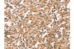 The image on the left is immunohistochemistry of paraffin-embedded Human thyroid cancer tissue using CSB-PA565667(CYP46A1 Antibody) at dilution 1/15, on the right is treated with synthetic peptide. (Original magnification: 