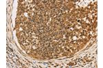 The image on the left is immunohistochemistry of paraffin-embedded Human cervical cancer tissue using CSB-PA565730(CXXC5 Antibody) at dilution 1/20, on the right is treated with fusion protein. (Original magnification: 