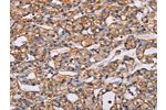 The image on the left is immunohistochemistry of paraffin-embedded Human prostate cancer tissue using CSB-PA565827(ARAP1 Antibody) at dilution 1/40, on the right is treated with synthetic peptide. (Original magnification: 