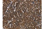 The image on the left is immunohistochemistry of paraffin-embedded Human cervical cancer tissue using CSB-PA566041(FASTKD2 Antibody) at dilution 1/50, on the right is treated with fusion protein. (Original magnification: 