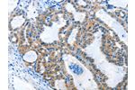The image on the left is immunohistochemistry of paraffin-embedded Human thyroid cancer tissue using CSB-PA566307(ANKMY1 Antibody) at dilution 1/25, on the right is treated with fusion protein. (Original magnification: 