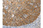 The image on the left is immunohistochemistry of paraffin-embedded Human cervical cancer tissue using CSB-PA566518(APOBEC3G Antibody) at dilution 1/50, on the right is treated with fusion protein. (Original magnification: 