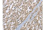 The image on the left is immunohistochemistry of paraffin-embedded Human esophagus cancer tissue using CSB-PA568195(ECHS1 Antibody) at dilution 1/35, on the right is treated with fusion protein. (Original magnification: 