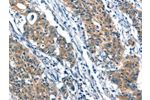 The image on the left is immunohistochemistry of paraffin-embedded Human gastic cancer tissue using CSB-PA568477(A4GALT Antibody) at dilution 1/30, on the right is treated with synthetic peptide. (Original magnification: 
