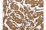 The image on the left is immunohistochemistry of paraffin-embedded Human breast cancer tissue using CSB-PA568771(CXCL14 Antibody) at dilution 1/60, on the right is treated with fusion protein. (Original magnification: 