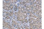 The image on the left is immunohistochemistry of paraffin-embedded Human thyroid cancer tissue using CSB-PA568889(FAR2 Antibody) at dilution 1/50, on the right is treated with fusion protein. (Original magnification: 