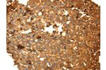 The image on the left is immunohistochemistry of paraffin-embedded Human breast cancer tissue using CSB-PA568903(DRD5 Antibody) at dilution 1/40, on the right is treated with fusion protein. (Original magnification: 