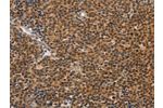 The image on the left is immunohistochemistry of paraffin-embedded Human Lymphoma tissue using CSB-PA569109(CD36 Antibody) at dilution 1/60, on the right is treated with synthetic peptide. (Original magnification: 