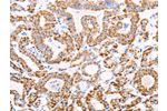 The image on the left is immunohistochemistry of paraffin-embedded Human thyroid cancer tissue using CSB-PA569426(ATPIF1 Antibody) at dilution 1/50, on the right is treated with fusion protein. (Original magnification: 